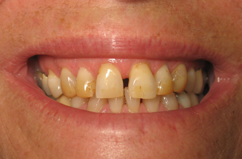 Coffee Stained Teeth Pictures